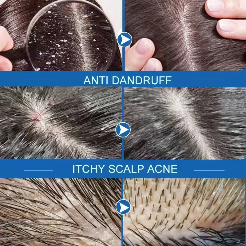 Fast Anti Dandruff Hair Treatm - Hair Care Dandruff ulasan dan harga