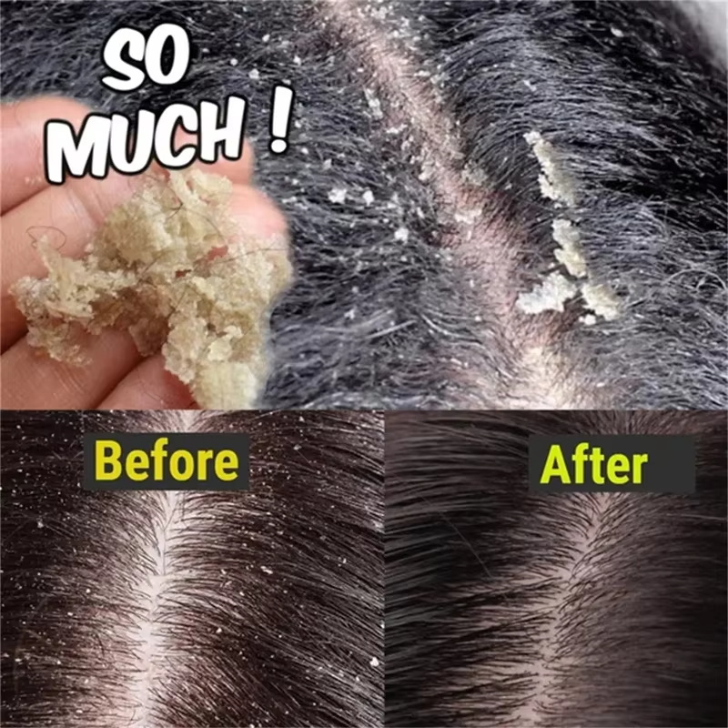 Fast Anti Dandruff Hair Treatm - Hair Care Dandruff ulasan dan harga